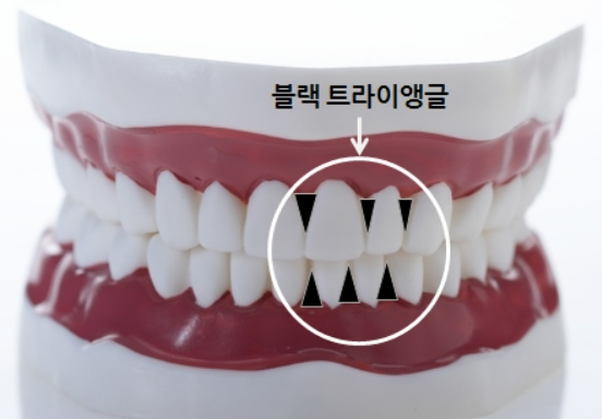 블랙 트라이앵글 설명 사진